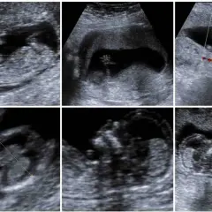 Ecografie fetali: immagini di un feto in utero, con misurazioni e flussi sanguigni. Si nota un movimento che potrebbe indicare un singhiozzo feto.