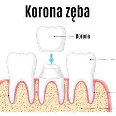 Ilustracja pokazuje proces zakładania korony na ząb. Dwa zdrowe zęby po bokach, a w środku ząb przygotowany do założenia korony, która jest umieszczona nad nim.