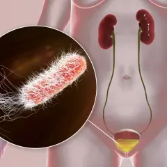 Gros plan sur un germe responsable d'une infection urinaire, montrant sa structure filamenteuse. Le système urinaire humain est également représenté.