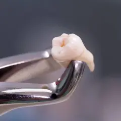 Pinzas dentales sujetan un diente extraído, resultado de una exodoncia dental.