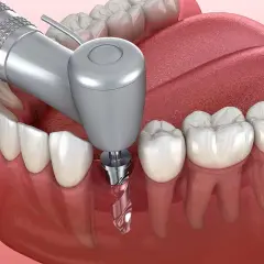 Procedimiento dental para colocar un implante. Conocer el coste de un implante dental es clave para tu salud bucal.