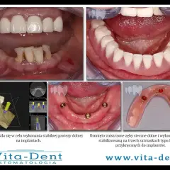 Proteza na belce stabilizowana na implantach. Widok przed i po leczeniu, planowanie implantacji.