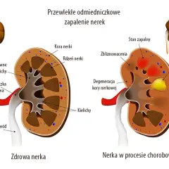 Choroba nerek: Co dzieje się z Twoim umysłem? Objawy i pomoc