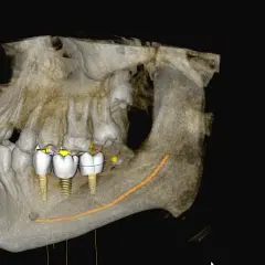 Trójwymiarowa tomografia stożkowa szczęki z widocznymi implantami zębowymi i planowaną ścieżką nerwu.