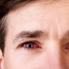 Gros plan sur les yeux d'un homme, l'un d'eux est rouge et irrité, présentant des symptômes de conjonctivite.