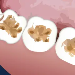 Denti con cavità interne, una carie interna non visibile che distrugge la struttura dall'interno.