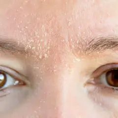 Nahaufnahme von trockener, schuppiger Haut auf der Stirn über braunen Augen.