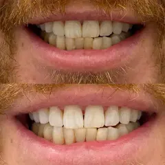 Wybielanie zębów u dentysty: efekty, koszty czy warto?