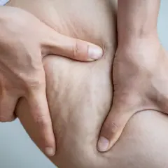 Jak pozbyć się cellulitu z ud? Domowe sposoby i zabiegi