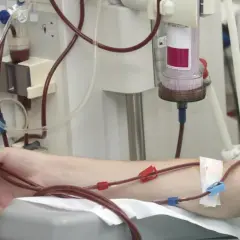 Ramię pacjenta podłączone do maszyny do dializy. Czerwone wężyki prowadzą krew do aparatu, który oczyszcza ją z toksyn.