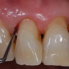 Strumento dentale che causa sanguinamento gengive vicino a un dente.
