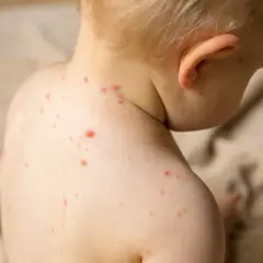 Skóra dziecka z licznymi czerwonymi kropkami, objawami ospy.