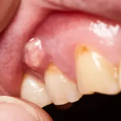 Gengiva gonfia con ascesso, un segnale che richiede attenzione per i rimedi.