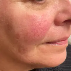 Närbild på en kvinnas kind med synliga röda blodkärl, ett vanligt tecken på rosacea. Fokuserar på hudvård för att hantera tillståndet.