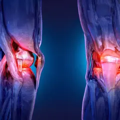 Représentation artistique des genoux, avec une zone rouge vif indiquant une douleur intense, évoquant le craquement des articulations et le cancer.