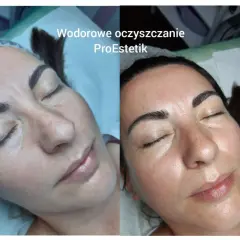 Przed i po zabiegu wodorowym na twarz. Skóra po oczyszczaniu jest promienna i nawilżona.