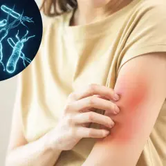 Bakterie Helicobacter pylori mogą wywoływać nie tylko problemy żołądkowe, ale także helicobacter pylori objawy skórne, takie jak zaczerwienienie i swędzenie ramienia.