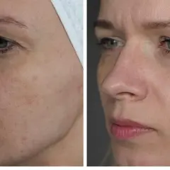 Przed i po zabiegu laserem frakcyjnym. Widoczna poprawa tekstury skóry, redukcja przebarwień i naczynek. Laser frakcyjny gojenie przyspiesza regenerację.