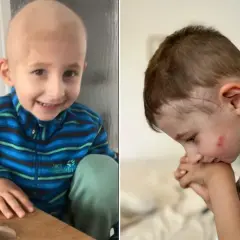 Ein Junge mit Glatze spielt mit Knete. Ein anderes Bild zeigt ihn mit Narben am Kopf, was auf eine Behandlung von Neuroblastom hindeutet.