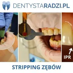 Zabieg stripping zębów: stomatolog używa narzędzi do delikatnego modelowania przestrzeni międzyzębowych (IPR).