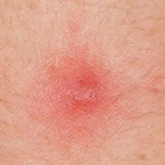 Czerwona, zapalna krostka na skórze, która może wymagać leczenia detreomycyną 2.