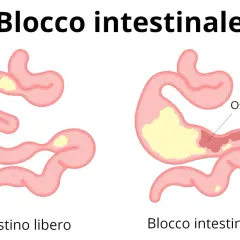 Illustrazione di un intestino libero e di un blocco intestinale, che spiega perché non riesco ad andare in bagno.