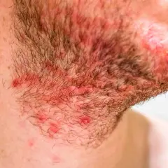 Gros plan sur la barbe d'un homme, montrant une irritation et une rougeur au cou, avec quelques boutons visibles.
