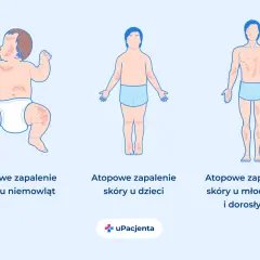 Ilustracja pokazuje atopowe zapalenie skóry u niemowląt, dzieci i dorosłych, uwidaczniając typowe objawy na skórze w różnych grupach wiekowych.