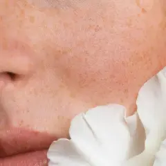 Piel con pecas y un pétalo blanco. Las ceramidas para que sirve: restauran la barrera cutánea, hidratan y protegen.