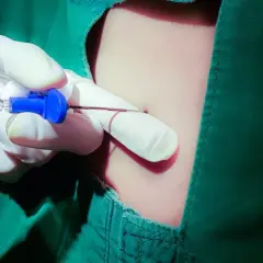 Rękawiczka w białej rękawiczce podaje zastrzyk, wykonując znieczulenie nasiękowe.