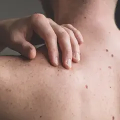 Mano che si gratta la schiena, con molti nei e lentiggini. Un fastidioso prurito schiena senza rossore.