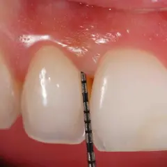 Sonda periodontal mide la profundidad de la encía. La piorrea se pega si no se cuida.
