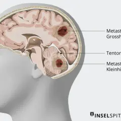 Schnitt durch ein Gehirn mit Metastasen im Großhirn und Kleinhirn. Die Darstellung zeigt, wie Metastasen im Kopf das Leben beeinflussen können.