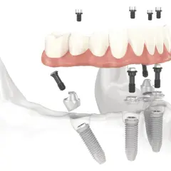 Impianti dentali e protesi, un ponte per un sorriso perfetto.