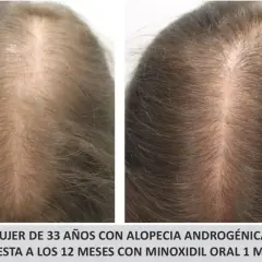 Comparativa de cabello de mujer de 33 años con alopecia androgenética, mostrando mejora tras 12 meses de tratamiento con minoxidil oral.