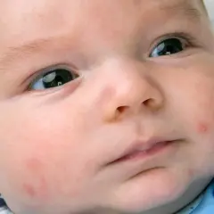 Viso di neonato con arrossamenti e piccole pustole. Se noti una reazione allergica neonato cosa fare? Consulta il pediatra.