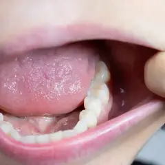 Usta z językiem i zębami, lekko rozchylone. Może to być **afta po wizycie u dentysty**, która powoduje dyskomfort.