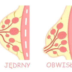 Ilustracja porównuje jędrne i obwisłe piersi, pokazując różnice w ich strukturze.