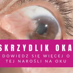 Zbliżenie na oko z widocznym skrzydlikiem. Różowy pasek z tekstem "SKRZYDLIK OKA".