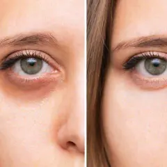 Vorher/Nachher-Vergleich: Ein blasses Gesicht mit deutlichen Augenringen wird durch eine Behandlung aufgehellt, die die Augenringe reduziert.