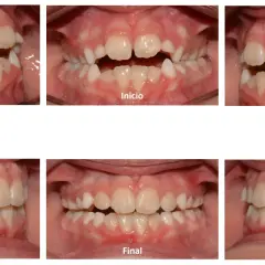 Niño con mordida abierta antes y después. Las imágenes muestran la corrección de la alineación dental, logrando una oclusión perfecta.