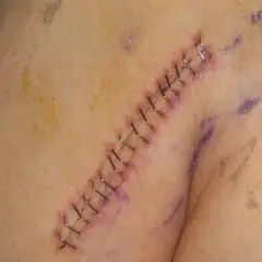 Gros plan sur une cicatrice suturée avec des agrafes chirurgicales. Un point de suture qui saute est visible, indiquant une possible complication.