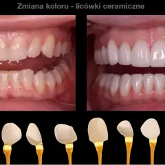 Przed i po metamorfozie zębów: od naturalnego koloru do olśniewającego, hollywoodzki uśmiech dzięki licówkom ceramicznym.