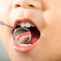 Bambino con bocca aperta e specchietto dentale. Si intravedono i denti, ma l'immagine suggerisce la preoccupazione per i denti marci nei bambini.