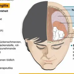 Hirnhautentzündung Diagnostik: So erkennen Sie die Symptome rechtzeitig