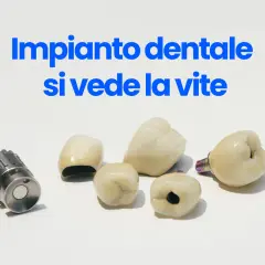 Componenti di un impianto dentale, inclusa una vite, su sfondo bianco.