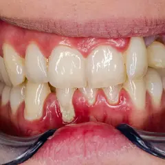 Gengive gonfie e arrossate, segno di gengivite acuta. Si nota un accumulo di placca tra i denti.