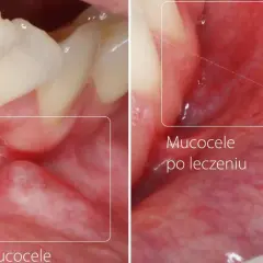Zmiana na policzku: torbiel przed i po leczeniu. Widoczne zęby i błona śluzowa jamy ustnej.