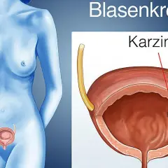 Illustration zeigt eine weibliche Figur und eine Blase mit einem Karzinom. Mögliche blasenkrebs symptome werden hier visuell dargestellt.
