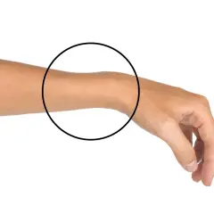 Braccio con cerchio che evidenzia la zona del polso, indicativa di una frattura Colles.